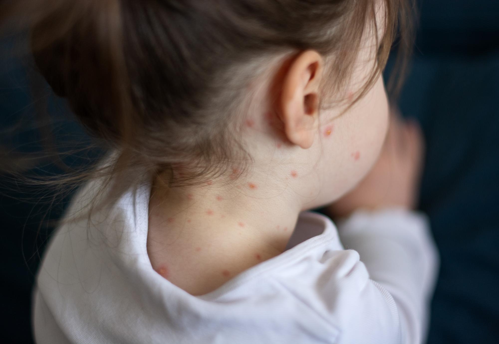 Child with measles