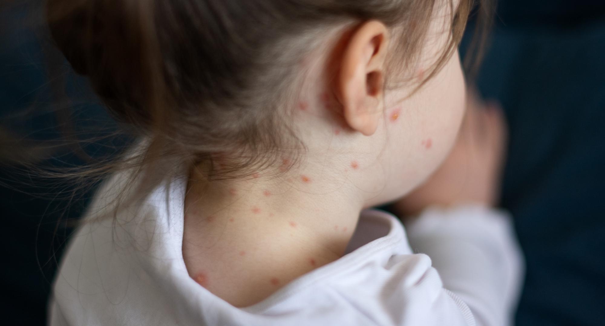 Child with measles