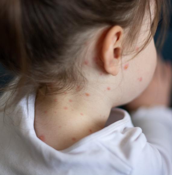 Child with measles